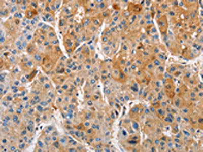The image on the left is immunohistochemistry of paraffin-embedded Human liver cancer tissue using the antibody Antibody) at dilution 1/50, on the right is treated with fusion protein. (Original magnification: ×200)Rabbit anti-Human PRKCE Polyclonal Antibody