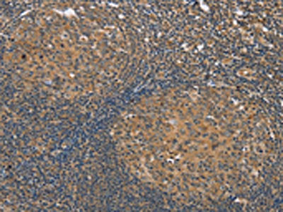 The image on the left is immunohistochemistry of paraffin-embedded Human tonsil tissue using KCNJ15 Antibody(KCNJ15 Antibody) at dilution 1/35, on the right is treated with synthetic peptide. (Original magnification: ×200)