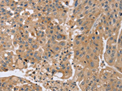 The image on the left is immunohistochemistry of paraffin-embedded Human breast cancer tissue using the antibody Antibody) at dilution 1/35, on the right is treated with synthetic peptide. (Original magnification: ×200)