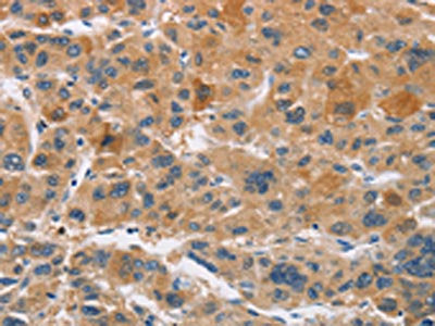 The image on the left is immunohistochemistry of paraffin-embedded Human liver cancer tissue using the antibody Antibody) at dilution 1/30, on the right is treated with fusion protein. (Original magnification: ×200)Rabbit anti-Human CYP4A11 Polyclonal Antibody