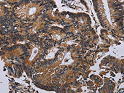 The image on the left is immunohistochemistry of paraffin-embedded Human colon cancer tissue using the antibody Antibody) at dilution 1/30, on the right is treated with synthetic peptide. (Original magnification: ×200)Rabbit anti-Human PCDHAC1 Polyclonal Antibody
