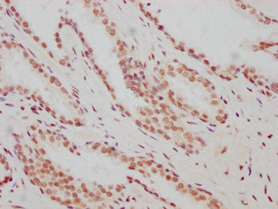 IHC image of ARNT Recombinant Monoclonal Antibody diluted at 1:183 and staining in paraffin-embedded human prostate cancer performed on a Leica BondTM system. After dewaxing and hydration, antigen retrieval was mediated by high pressure in a citrate buffer (pH 6.0). Section was blocked with 10% normal goat serum 30min at RT. Then primary antibody (1% BSA) was incubated at 4℃ overnight. The primary is detected by a biotinylated secondary antibody and visualized using an HRP conjugated SP system.ARNT Recombinant Monoclonal Antibody