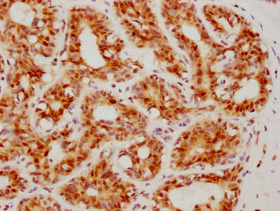 IHC image of ATF4 Recombinant Monoclonal Antibody diluted at 1:160 and staining in paraffin-embedded human breast cancer performed on a Leica BondTM system. After dewaxing and hydration, antigen retrieval was mediated by high pressure in a citrate buffer (pH 6.0). Section was blocked with 10% normal goat serum 30min at RT. Then primary antibody (1% BSA) was incubated at 4℃ overnight. The primary is detected by a biotinylated secondary antibody and visualized using an HRP conjugated SP system.ATF4 Recombinant Monoclonal Antibody