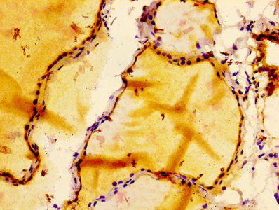 IHC image of BCL2 Recombinant Monoclonal Antibody diluted at 1:100 and staining in paraffin-embedded human thyroid tissue performed on a Leica BondTM system. After dewaxing and hydration, antigen retrieval was mediated by high pressure in a citrate buffer (pH 6.0). Section was blocked with 10% normal goat serum 30min at RT. Then primary antibody (1% BSA) was incubated at 4°C overnight. The primary is detected by a biotinylated secondary antibody and visualized using an HRP conjugated SP system.BCL2 Recombinant Monoclonal Antibody
