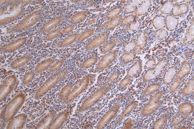 IHC image of CASP3 Recombinant Monoclonal Antibody diluted at 1:100 and staining in paraffin-embedded human breast cancer performed on a Leica BondTM system. After dewaxing and hydration, antigen retrieval was mediated by high pressure in a citrate buffer (pH 6.0). Section was blocked with 10% normal goat serum 30min at RT. Then primary antibody (1% BSA) was incubated at 4°C overnight. The primary is detected by a Goat anti-rabbit polymer IgG labeled by HRP and visualized using 0.18% DAB.