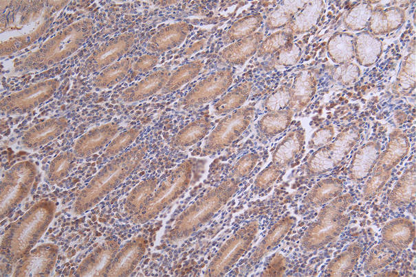 IHC image of CASP3 Recombinant Monoclonal Antibody diluted at 1:100 and staining in paraffin-embedded human breast cancer performed on a Leica BondTM system. After dewaxing and hydration, antigen retrieval was mediated by high pressure in a citrate buffer (pH 6.0). Section was blocked with 10% normal goat serum 30min at RT. Then primary antibody (1% BSA) was incubated at 4°C overnight. The primary is detected by a Goat anti-rabbit polymer IgG labeled by HRP and visualized using 0.18% DAB.