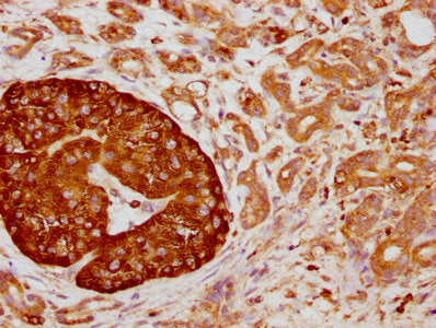 IHC image of the antibody diluted at 1:155 and staining in paraffin-embedded human pancreatic cancer performed on a Leica BondTM system. After dewaxing and hydration, antigen retrieval was mediated by high pressure in a citrate buffer (pH 6.0). Section was blocked with 10% normal goat serum 30min at RT. Then primary antibody (1% BSA) was incubated at 4℃ overnight. The primary is detected by a biotinylated secondary antibody and visualized using an HRP conjugated SP system.