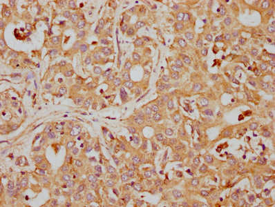 IHC image of CD63 Recombinant Monoclonal Antibody diluted at 1:155 and staining in paraffin-embedded human liver cancer performed on a Leica BondTM system. After dewaxing and hydration, antigen retrieval was mediated by high pressure in a citrate buffer (pH 6.0). Section was blocked with 10% normal goat serum 30min at RT. Then primary antibody (1% BSA) was incubated at 4℃ overnight. The primary is detected by a biotinylated secondary antibody and visualized using an HRP conjugated SP system.