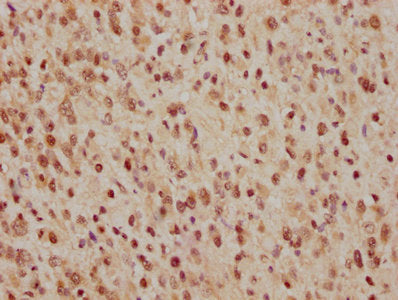 IHC image of CDC25C Recombinant Monoclonal Antibody diluted at 1:165 and staining in paraffin-embedded human glioma cancer performed on a Leica BondTM system. After dewaxing and hydration, antigen retrieval was mediated by high pressure in a citrate buffer (pH 6.0). Section was blocked with 10% normal goat serum 30min at RT. Then primary antibody (1% BSA) was incubated at 4℃ overnight. The primary is detected by a biotinylated secondary antibody and visualized using an HRP conjugated SP system.