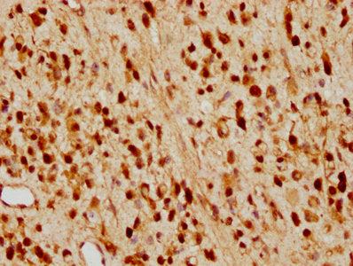 IHC image of CDKN1B Recombinant Monoclonal Antibody diluted at 1:97.5 and staining in paraffin-embedded human glioma cancer performed on a Leica BondTM system. After dewaxing and hydration, antigen retrieval was mediated by high pressure in a citrate buffer (pH 6.0). Section was blocked with 10% normal goat serum 30min at RT. Then primary antibody (1% BSA) was incubated at 4℃ overnight. The primary is detected by a biotinylated secondary antibody and visualized using an HRP conjugated SP system.