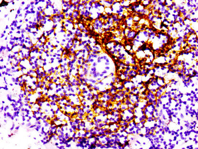 IHC image of CD21 Recombinant Monoclonal Antibody diluted at 1:100 and staining in paraffin-embedded human lung cancer performed on a Leica BondTM system. After dewaxing and hydration, antigen retrieval was mediated by high pressure in a citrate buffer (pH 6.0). Section was blocked with 10% normal goat serum 30min at RT. Then primary antibody (1% BSA) was incubated at 4℃ overnight. The primary is detected by a biotinylated secondary antibody and visualized using an HRP conjugated SP system.