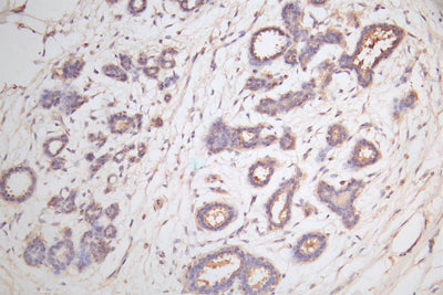 IHC image of the antibody diluted at 1:100 and staining in paraffin-embedded human breast tissue performed on a Leica BondTM system. After dewaxing and hydration, antigen retrieval was mediated by high pressure in a citrate buffer (pH 6.0). Section was blocked with 10% normal goat serum 30min at RT. Then primary antibody (1% BSA) was incubated at 4°C overnight. The primary is detected by a Goat anti-rabbit polymer IgG labeled by HRP and visualized using 0.05% DAB.
