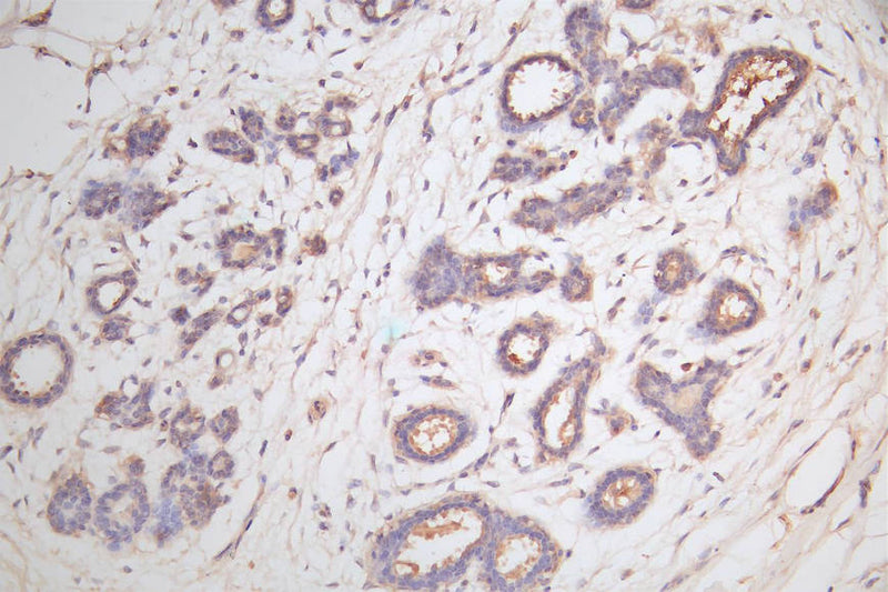 IHC image of the antibody diluted at 1:100 and staining in paraffin-embedded human breast tissue performed on a Leica BondTM system. After dewaxing and hydration, antigen retrieval was mediated by high pressure in a citrate buffer (pH 6.0). Section was blocked with 10% normal goat serum 30min at RT. Then primary antibody (1% BSA) was incubated at 4°C overnight. The primary is detected by a Goat anti-rabbit polymer IgG labeled by HRP and visualized using 0.05% DAB.