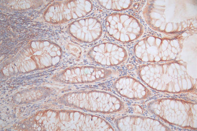IHC image of CTNNB1 Recombinant Monoclonal Antibody diluted at 1:100 and staining in paraffin-embedded human rectal cancer performed on a Leica BondTM system. After dewaxing and hydration, antigen retrieval was mediated by high pressure in a citrate buffer (pH 6.0). Section was blocked with 10% normal goat serum 30min at RT. Then primary antibody (1% BSA) was incubated at 4°C overnight. The primary is detected by a Goat anti-rabbit polymer IgG labeled by HRP and visualized using 0.05% DAB.