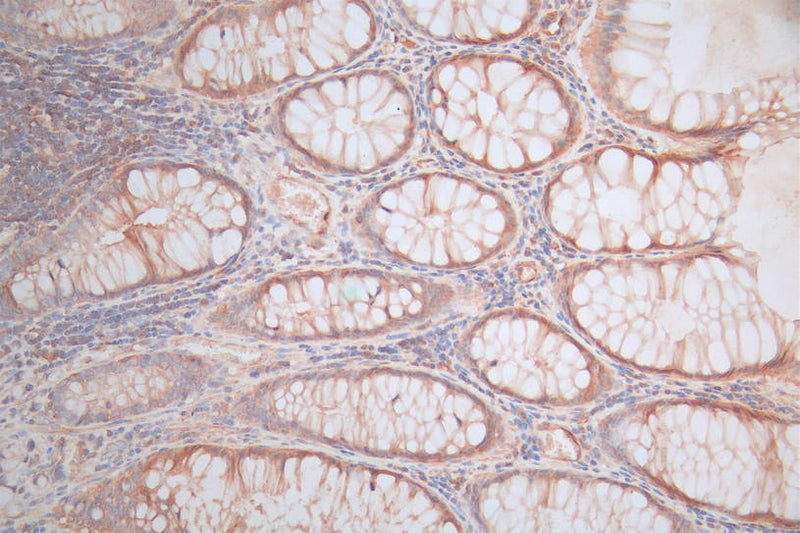 IHC image of CTNNB1 Recombinant Monoclonal Antibody diluted at 1:100 and staining in paraffin-embedded human rectal cancer performed on a Leica BondTM system. After dewaxing and hydration, antigen retrieval was mediated by high pressure in a citrate buffer (pH 6.0). Section was blocked with 10% normal goat serum 30min at RT. Then primary antibody (1% BSA) was incubated at 4°C overnight. The primary is detected by a Goat anti-rabbit polymer IgG labeled by HRP and visualized using 0.05% DAB.