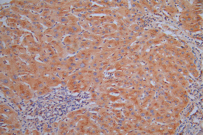 IHC image of the antibody diluted at 1:30 and staining in paraffin-embedded human liver cancer performed on a Leica BondTM system. After dewaxing and hydration, antigen retrieval was mediated by high pressure in a citrate buffer (pH 6.0). Section was blocked with 10% normal goat serum 30min at RT. Then primary antibody (1% BSA) was incubated at 4°C overnight. The primary is detected by a Goat anti-Mouse IgG labeled by HRP and visualized using 0.05% DAB.