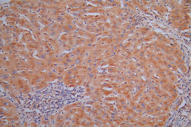 IHC image of the antibody diluted at 1:30 and staining in paraffin-embedded human liver cancer performed on a Leica BondTM system. After dewaxing and hydration, antigen retrieval was mediated by high pressure in a citrate buffer (pH 6.0). Section was blocked with 10% normal goat serum 30min at RT. Then primary antibody (1% BSA) was incubated at 4°C overnight. The primary is detected by a Goat anti-Mouse IgG labeled by HRP and visualized using 0.05% DAB.
