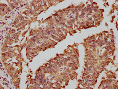 IHC image of FOS Recombinant Monoclonal Antibody diluted at 1:81 and staining in paraffin-embedded human cervical cancer performed on a Leica BondTM system. After dewaxing and hydration, antigen retrieval was mediated by high pressure in a citrate buffer (pH 6.0). Section was blocked with 10% normal goat serum 30min at RT. Then primary antibody (1% BSA) was incubated at 4℃ overnight. The primary is detected by a biotinylated secondary antibody and visualized using an HRP conjugated SP system.FOS Recombinant Monoclonal Antibody
