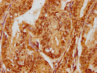 IHC image of FOXO3 Recombinant Monoclonal Antibody diluted at 1:180 and staining in paraffin-embedded human endometrial cancer performed on a Leica BondTM system. After dewaxing and hydration, antigen retrieval was mediated by high pressure in a citrate buffer (pH 6.0). Section was blocked with 10% normal goat serum 30min at RT. Then primary antibody (1% BSA) was incubated at 4℃ overnight. The primary is detected by a biotinylated secondary antibody and visualized using an HRP conjugated SP system.FOXO3 Recombinant Monoclonal Antibody