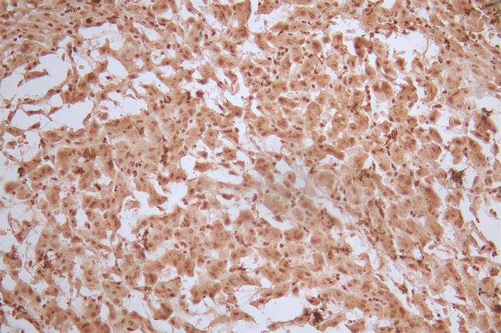 IHC image of FTH1 Recombinant Monoclonal Antibody diluted at 1:50 and staining in paraffin-embedded human liver tissue performed on a Leica BondTM system. After dewaxing and hydration, antigen retrieval was mediated by high pressure in a citrate buffer (pH 6.0). Section was blocked with 10% normal goat serum 30min at RT. Then primary antibody (1% BSA) was incubated at 4°C overnight. The primary is detected by a Goat anti-Mouse IgG labeled by HRP and visualized using 0.05% DAB.FTH1 Recombinant Monoclonal Antibody