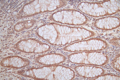IHC image of FTH1 Recombinant Monoclonal Antibody diluted at 1:50 and staining in paraffin-embedded human rectal cancer performed on a Leica BondTM system. After dewaxing and hydration, antigen retrieval was mediated by high pressure in a citrate buffer (pH 6.0). Section was blocked with 10% normal goat serum 30min at RT. Then primary antibody (1% BSA) was incubated at 4°C overnight. The primary is detected by a Goat anti-Mouse IgG labeled by HRP and visualized using 0.05% DAB.FTH1 Recombinant Monoclonal Antibody