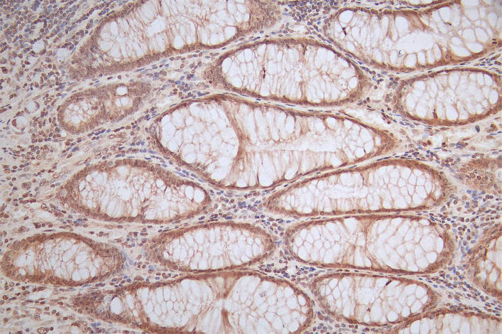 IHC image of FTH1 Recombinant Monoclonal Antibody diluted at 1:50 and staining in paraffin-embedded human rectal cancer performed on a Leica BondTM system. After dewaxing and hydration, antigen retrieval was mediated by high pressure in a citrate buffer (pH 6.0). Section was blocked with 10% normal goat serum 30min at RT. Then primary antibody (1% BSA) was incubated at 4°C overnight. The primary is detected by a Goat anti-Mouse IgG labeled by HRP and visualized using 0.05% DAB.FTH1 Recombinant Monoclonal Antibody