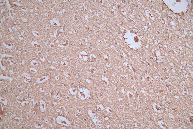 IHC image of GFAP Recombinant Monoclonal Antibody diluted at 1:300 and staining in paraffin-embedded human brain tissue performed on a Leica BondTM system. After dewaxing and hydration, antigen retrieval was mediated by high pressure in a citrate buffer (pH 6.0). Section was blocked with 10% normal goat serum 30min at RT. Then primary antibody (1% BSA) was incubated at 4°C overnight. The primary is detected by a Goat anti-Mouse IgG labeled by HRP and visualized using 0.05% DAB.GFAP Recombinant Monoclonal Antibody