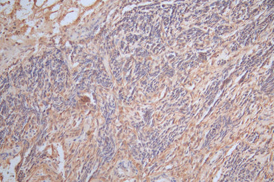 IHC image of GFAP Recombinant Monoclonal Antibody diluted at 1:300 and staining in paraffin-embedded human glioma cancer performed on a Leica BondTM system. After dewaxing and hydration, antigen retrieval was mediated by high pressure in a citrate buffer (pH 6.0). Section was blocked with 10% normal goat serum 30min at RT. Then primary antibody (1% BSA) was incubated at 4°C overnight. The primary is detected by a Goat anti-Mouse IgG labeled by HRP and visualized using 0.05% DAB.GFAP Recombinant Monoclonal Antibody