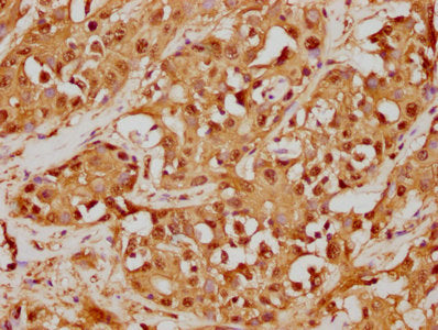 IHC image of GSTO1 Recombinant Monoclonal Antibody diluted at 1:125 and staining in paraffin-embedded human liver cancer performed on a Leica BondTM system. After dewaxing and hydration, antigen retrieval was mediated by high pressure in a citrate buffer (pH 6.0). Section was blocked with 10% normal goat serum 30min at RT. Then primary antibody (1% BSA) was incubated at 4℃ overnight. The primary is detected by a biotinylated secondary antibody and visualized using an HRP conjugated SP system.GSTO1 Recombinant Monoclonal Antibody
