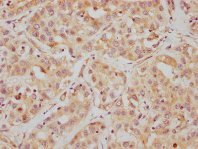 IHC image of HDAC6 Recombinant Monoclonal Antibody diluted at 1:112.5 and staining in paraffin-embedded human liver cancer performed on a Leica BondTM system. After dewaxing and hydration, antigen retrieval was mediated by high pressure in a citrate buffer (pH 6.0). Section was blocked with 10% normal goat serum 30min at RT. Then primary antibody (1% BSA) was incubated at 4℃ overnight. The primary is detected by a biotinylated secondary antibody and visualized using an HRP conjugated SP system.HDAC6 Recombinant Monoclonal Antibody