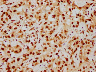 IHC image of HDAC9 Recombinant Monoclonal Antibody diluted at 1:154 and staining in paraffin-embedded human liver cancer performed on a Leica BondTM system. After dewaxing and hydration, antigen retrieval was mediated by high pressure in a citrate buffer (pH 6.0). Section was blocked with 10% normal goat serum 30min at RT. Then primary antibody (1% BSA) was incubated at 4℃ overnight. The primary is detected by a biotinylated secondary antibody and visualized using an HRP conjugated SP system.HDAC9 Recombinant Monoclonal Antibody