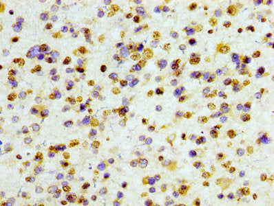 IHC image of Histone H3.1 Recombinant Monoclonal Antibody diluted at 1:100 and staining in paraffin-embedded human glioma cancer performed on a Leica BondTM system. After dewaxing and hydration, antigen retrieval was mediated by high pressure in a citrate buffer (pH 6.0). Section was blocked with 10% normal goat serum 30min at RT. Then primary antibody (1% BSA) was incubated at 4℃ overnight. The primary is detected by a biotinylated secondary antibody and visualized using an HRP conjugated SP system.Histone H3.1 Recombinant Monoclonal Antibody