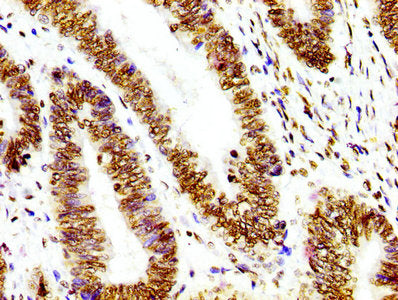 IHC image of Histone H3.1 Recombinant Monoclonal Antibody diluted at 1:100 and staining in paraffin-embedded human colon cancer performed on a Leica BondTM system. After dewaxing and hydration, antigen retrieval was mediated by high pressure in a citrate buffer (pH 6.0). Section was blocked with 10% normal goat serum 30min at RT. Then primary antibody (1% BSA) was incubated at 4℃ overnight. The primary is detected by a biotinylated secondary antibody and visualized using an HRP conjugated SP system.Histone H3.1 Recombinant Monoclonal Antibody