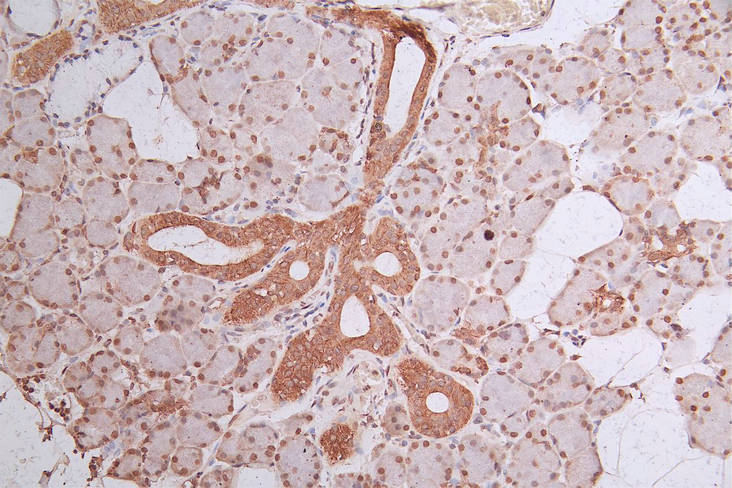 IHC image of HIST1H3A Recombinant Monoclonal Antibody diluted at 1:300 and staining in paraffin-embedded human gastric cancer performed on a Leica BondTM system. After dewaxing and hydration, antigen retrieval was mediated by high pressure in a citrate buffer (pH 6.0). Section was blocked with 10% normal goat serum 30min at RT. Then primary antibody (1% BSA) was incubated at 4°C overnight. The primary is detected by a Goat anti-Mouse IgG labeled by HRP and visualized using 0.05% DAB.HIST1H3A Recombinant Monoclonal Antibody