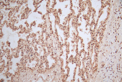 IHC image of HIST1H4A Recombinant Monoclonal Antibody diluted at 1:300 and staining in paraffin-embedded human lung tissue performed on a Leica BondTM system. After dewaxing and hydration, antigen retrieval was mediated by high pressure in a citrate buffer (pH 6.0). Section was blocked with 10% normal goat serum 30min at RT. Then primary antibody (1% BSA) was incubated at 4°C overnight. The primary is detected by a Goat anti-Mouse IgG labeled by HRP and visualized using 0.05% DAB.HIST1H4A Recombinant Monoclonal Antibody