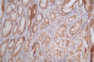 IHC image of HIST1H4A Recombinant Monoclonal Antibody diluted at 1:300 and staining in paraffin-embedded human gastric cancer performed on a Leica BondTM system. After dewaxing and hydration, antigen retrieval was mediated by high pressure in a citrate buffer (pH 6.0). Section was blocked with 10% normal goat serum 30min at RT. Then primary antibody (1% BSA) was incubated at 4°C overnight. The primary is detected by a Goat anti-Mouse IgG labeled by HRP and visualized using 0.05% DAB.HIST1H4A Recombinant Monoclonal Antibody