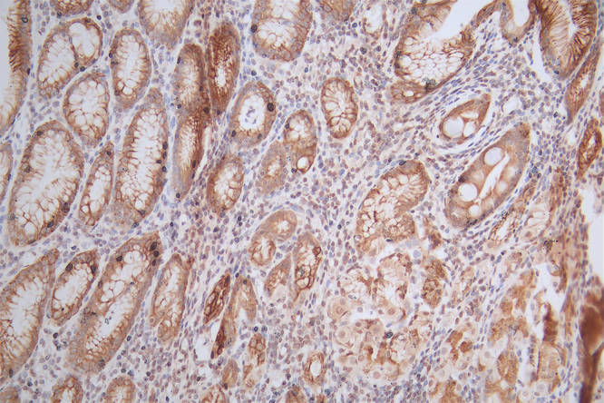 IHC image of HIST1H4A Recombinant Monoclonal Antibody diluted at 1:300 and staining in paraffin-embedded human gastric cancer performed on a Leica BondTM system. After dewaxing and hydration, antigen retrieval was mediated by high pressure in a citrate buffer (pH 6.0). Section was blocked with 10% normal goat serum 30min at RT. Then primary antibody (1% BSA) was incubated at 4°C overnight. The primary is detected by a Goat anti-Mouse IgG labeled by HRP and visualized using 0.05% DAB.HIST1H4A Recombinant Monoclonal Antibody