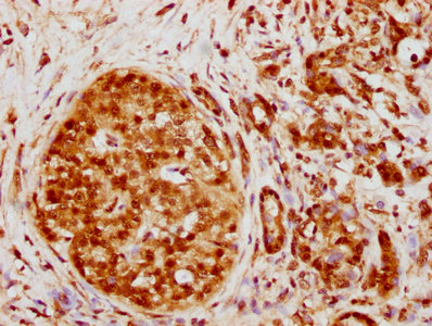 IHC image of HNRNPK Recombinant Monoclonal Antibody diluted at 1:130.5 and staining in paraffin-embedded human pancreatic cancer performed on a Leica BondTM system. After dewaxing and hydration, antigen retrieval was mediated by high pressure in a citrate buffer (pH 6.0). Section was blocked with 10% normal goat serum 30min at RT. Then primary antibody (1% BSA) was incubated at 4℃ overnight. The primary is detected by a biotinylated secondary antibody and visualized using an HRP conjugated SP system.HNRNPK Recombinant Monoclonal Antibody