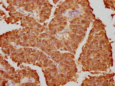 IHC image of HNRNPK Recombinant Monoclonal Antibody diluted at 1:130.5 and staining in paraffin-embedded human cervical cancer performed on a Leica BondTM system. After dewaxing and hydration, antigen retrieval was mediated by high pressure in a citrate buffer (pH 6.0). Section was blocked with 10% normal goat serum 30min at RT. Then primary antibody (1% BSA) was incubated at 4℃ overnight. The primary is detected by a biotinylated secondary antibody and visualized using an HRP conjugated SP system.HNRNPK Recombinant Monoclonal Antibody