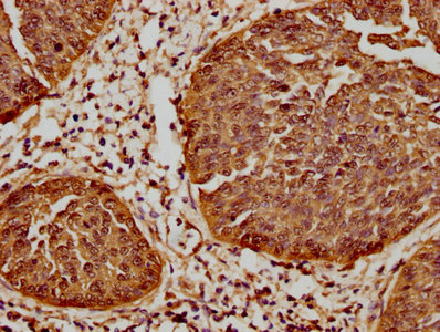 IHC image of HSPB1 Recombinant Monoclonal Antibody diluted at 1:61.9 and staining in paraffin-embedded human cervical cancer performed on a Leica BondTM system. After dewaxing and hydration, antigen retrieval was mediated by high pressure in a citrate buffer (pH 6.0). Section was blocked with 10% normal goat serum 30min at RT. Then primary antibody (1% BSA) was incubated at 4℃ overnight. The primary is detected by a biotinylated secondary antibody and visualized using an HRP conjugated SP system.