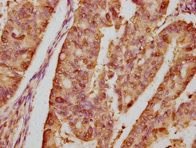 IHC image of HSP90AA1 Recombinant Monoclonal Antibody diluted at 1:80 and staining in paraffin-embedded human endometrial cancer performed on a Leica BondTM system. After dewaxing and hydration, antigen retrieval was mediated by high pressure in a citrate buffer (pH 6.0). Section was blocked with 10% normal goat serum 30min at RT. Then primary antibody (1% BSA) was incubated at 4℃ overnight. The primary is detected by a biotinylated secondary antibody and visualized using an HRP conjugated SP system.HSP90AA1 Recombinant Monoclonal Antibody