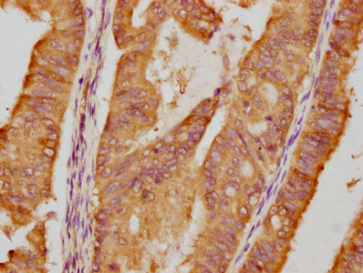 IHC image of the antibody diluted at 1:87.5 and staining in paraffin-embedded human endometrial cancer performed on a Leica BondTM system. After dewaxing and hydration, antigen retrieval was mediated by high pressure in a citrate buffer (pH 6.0). Section was blocked with 10% normal goat serum 30min at RT. Then primary antibody (1% BSA) was incubated at 4℃ overnight. The primary is detected by a biotinylated secondary antibody and visualized using an HRP conjugated SP system.HSP90AA1 Recombinant Monoclonal Antibody