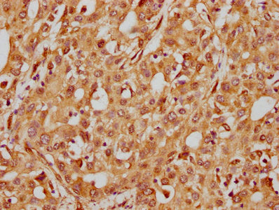 IHC image of ITGB1 Recombinant Monoclonal Antibody diluted at 1:185 and staining in paraffin-embedded human liver cancer performed on a Leica BondTM system. After dewaxing and hydration, antigen retrieval was mediated by high pressure in a citrate buffer (pH 6.0). Section was blocked with 10% normal goat serum 30min at RT. Then primary antibody (1% BSA) was incubated at 4℃ overnight. The primary is detected by a biotinylated secondary antibody and visualized using an HRP conjugated SP system.ITGB1 Recombinant Monoclonal Antibody
