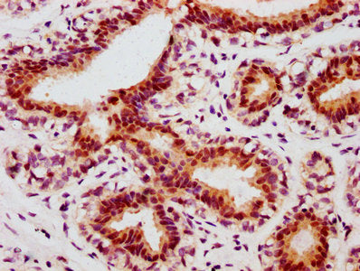 IHC image of Phospho-JUN (S63) Recombinant Monoclonal Antibody diluted at 1:100 and staining in paraffin-embedded human breast cancer performed on a Leica BondTM system. After dewaxing and hydration, antigen retrieval was mediated by high pressure in a citrate buffer (pH 6.0). Section was blocked with 10% normal goat serum 30min at RT. Then primary antibody (1% BSA) was incubated at 4°C overnight. The primary is detected by a biotinylated secondary antibody and visualized using an HRP conjugated SP system.Phospho-JUN (S63) Recombinant Monoclonal Antibody