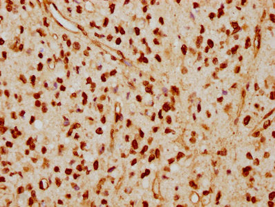 IHC image of the antibody diluted at 1:115 and staining in paraffin-embedded human glioma cancer performed on a Leica BondTM system. After dewaxing and hydration, antigen retrieval was mediated by high pressure in a citrate buffer (pH 6.0). Section was blocked with 10% normal goat serum 30min at RT. Then primary antibody (1% BSA) was incubated at 4℃ overnight. The primary is detected by a biotinylated secondary antibody and visualized using an HRP conjugated SP system.LMNA Recombinant Monoclonal Antibody