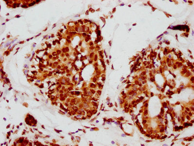 IHC image of LMNA Recombinant Monoclonal Antibody diluted at 1:115 and staining in paraffin-embedded human breast cancer performed on a Leica BondTM system. After dewaxing and hydration, antigen retrieval was mediated by high pressure in a citrate buffer (pH 6.0). Section was blocked with 10% normal goat serum 30min at RT. Then primary antibody (1% BSA) was incubated at 4℃ overnight. The primary is detected by a biotinylated secondary antibody and visualized using an HRP conjugated SP system.LMNA Recombinant Monoclonal Antibody