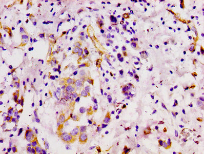IHC image of CD146 Recombinant Monoclonal Antibody diluted at 1:100 and staining in paraffin-embedded human breast cancer performed on a Leica BondTM system. After dewaxing and hydration, antigen retrieval was mediated by high pressure in a citrate buffer (pH 6.0). Section was blocked with 10% normal goat serum 30min at RT. Then primary antibody (1% BSA) was incubated at 4℃ overnight. The primary is detected by a biotinylated secondary antibody and visualized using an HRP conjugated SP system.