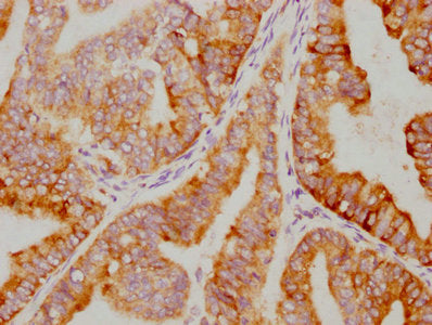 IHC image of NFKBIA Recombinant Monoclonal Antibody diluted at 1:79.75 and staining in paraffin-embedded human endometrial cancer performed on a Leica BondTM system. After dewaxing and hydration, antigen retrieval was mediated by high pressure in a citrate buffer (pH 6.0). Section was blocked with 10% normal goat serum 30min at RT. Then primary antibody (1% BSA) was incubated at 4℃ overnight. The primary is detected by a biotinylated secondary antibody and visualized using an HRP conjugated SP system.NFKBIA Recombinant Monoclonal Antibody