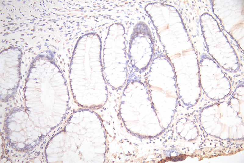 IHC image of PDPN Recombinant Monoclonal Antibody diluted at 1:300 and staining in paraffin-embedded human colorectal cancer performed on a Leica BondTM system. After dewaxing and hydration, antigen retrieval was mediated by high pressure in a citrate buffer (pH 6.0). Section was blocked with 10% normal goat serum 30min at RT. Then primary antibody (1% BSA) was incubated at 4°C overnight. The primary is detected by a Goat anti-Mouse IgG labeled by HRP and visualized using 0.05% DAB.PDPN Recombinant Monoclonal Antibody