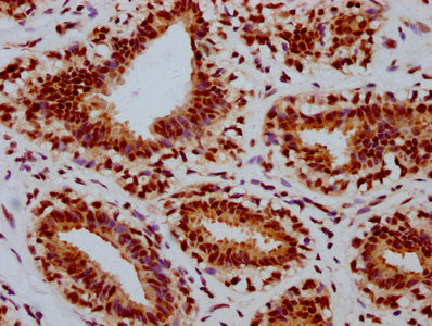 IHC image of the antibody diluted at 1:100 and staining in paraffin-embedded human breast cancer performed on a Leica BondTM system. After dewaxing and hydration, antigen retrieval was mediated by high pressure in a citrate buffer (pH 6.0). Section was blocked with 10% normal goat serum 30min at RT. Then primary antibody (1% BSA) was incubated at 4℃ overnight. The primary is detected by a biotinylated secondary antibody and visualized using an HRP conjugated SP system.Phospho-RB1 (S780) Recombinant Monoclonal Antibody